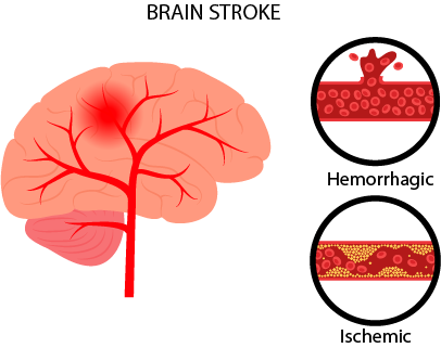 Brain stroke -Neurology services in Indore